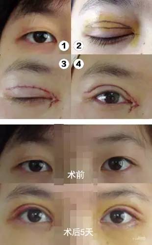 国产成人A在线观看视频免费:双眼皮手术最新,双眼皮手术最新趋势与国产成人A在线观看视频免费，探索美的多重维度